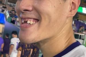 记者：王献均门牙留在了黄龙体育中心，很多人一起找都没找到